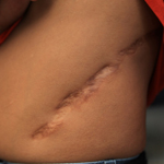Surgery scar, Quezon, Philippines.